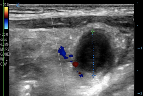 Acute appendicitis ultrasound image
